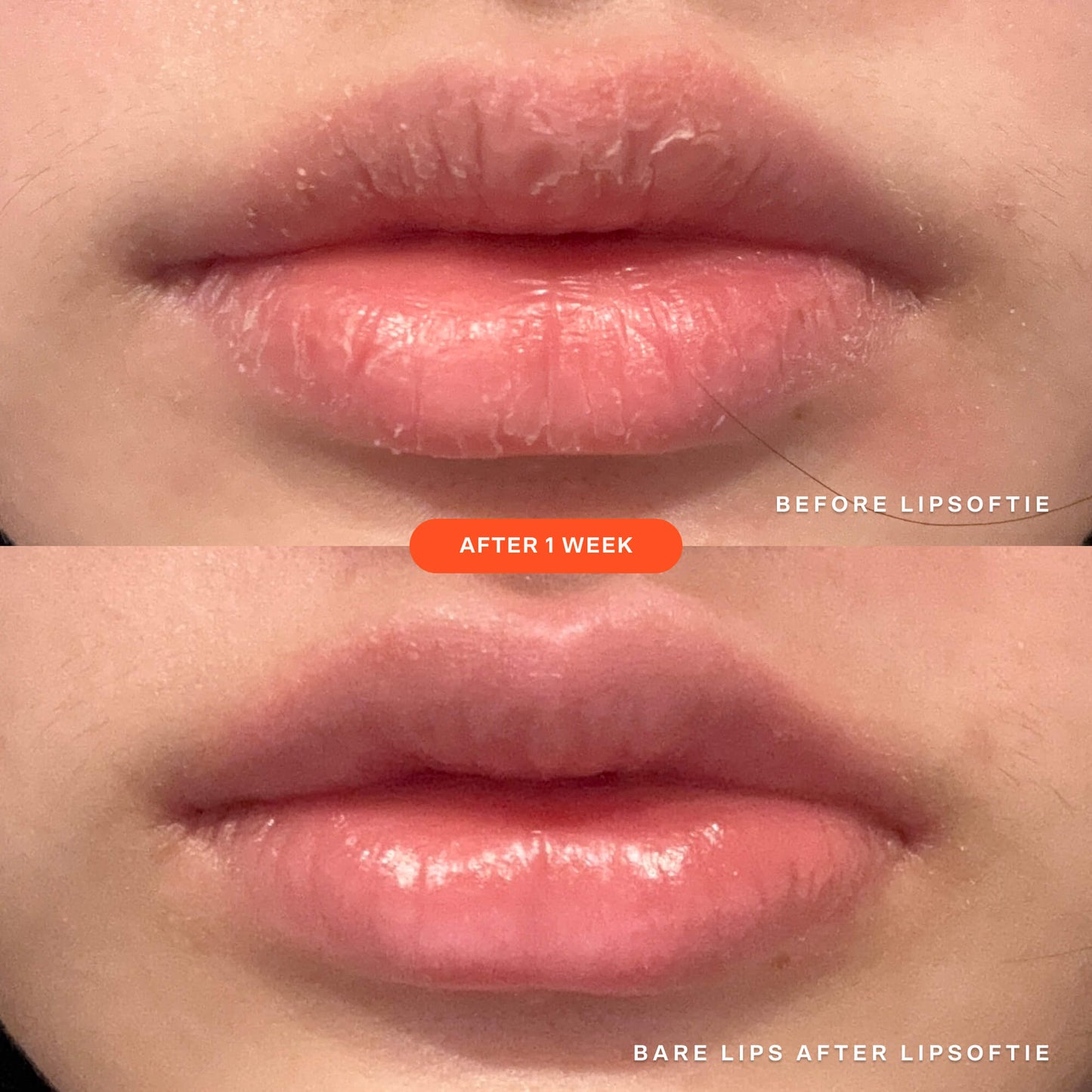 SOS LipSoftie® Lip Treatment