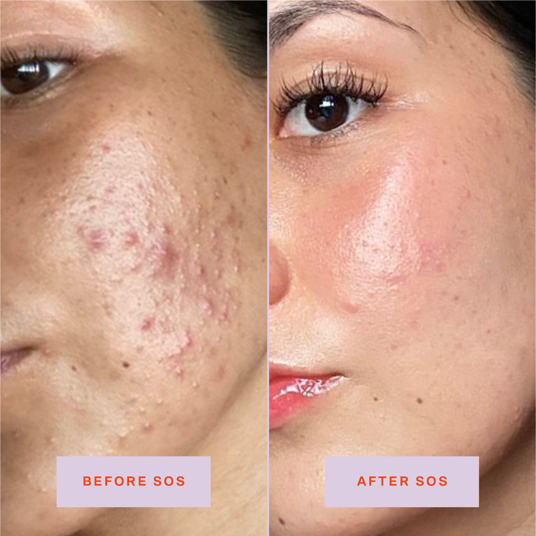 SOS Spray Duo