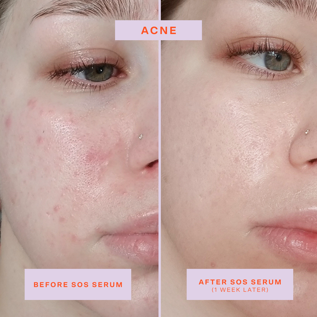 SOS Rescue Serum