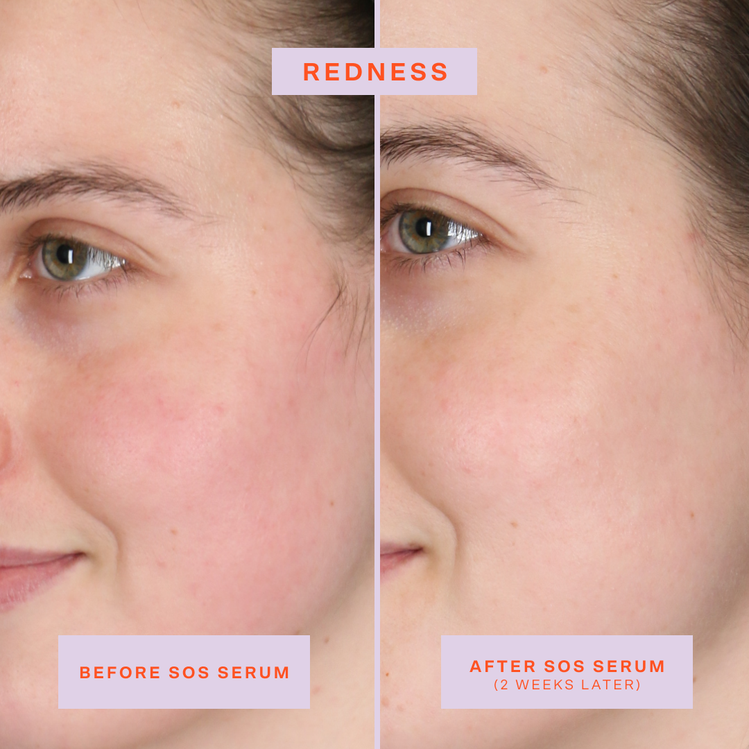 SOS Rescue Serum